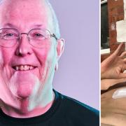 Jim Allen is taking part in The Show by Breast Cancer Now. Right, Jim pictured post-surgery.